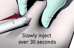 Administering Firmagon® dose step 4: aspirate, then depress