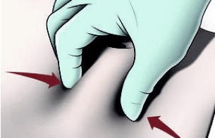 Administering Firmagon® dose step 2: elevate the subcutaneous tissue